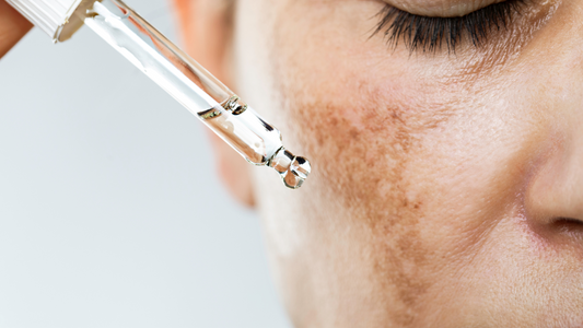 O que causa o melasma? Saiba também como tratar