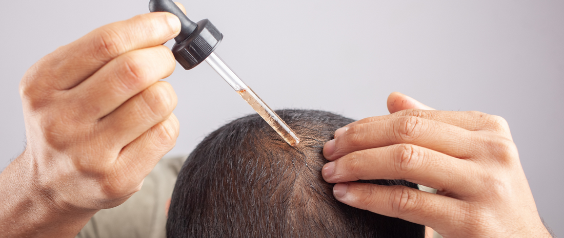 O Papel do Minoxidil no Tratamento da Calvície: Tópico e Oral